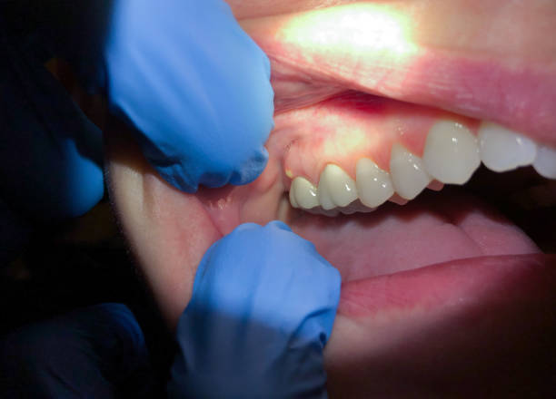 Best Emergency Dentist for Lost Fillings or Crowns in Yoncalla, OR
